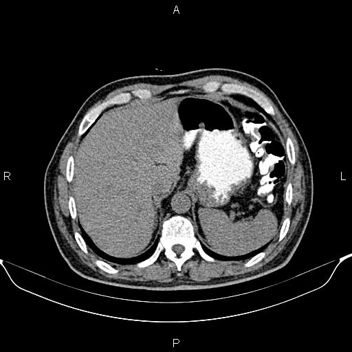 Cecal adenocarcinoma (Radiopaedia 85324-100916 Axial non-contrast 16).jpg