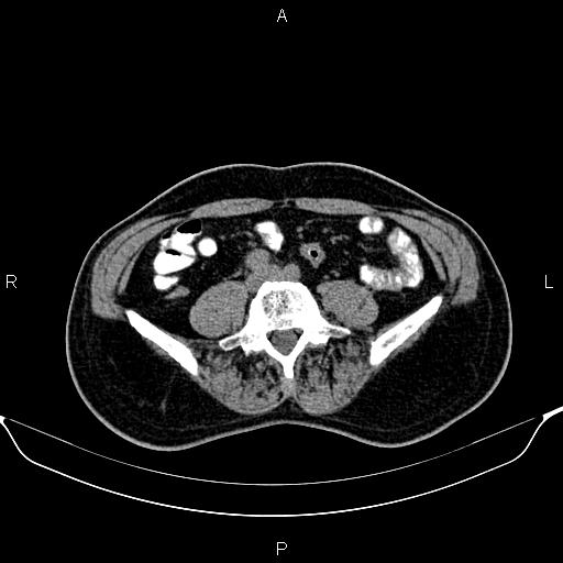 Cecal adenocarcinoma (Radiopaedia 85324-100916 Axial non-contrast 62).jpg