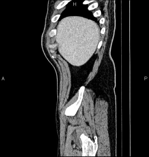 Cecal adenocarcinoma (Radiopaedia 85324-100916 E 9).jpg