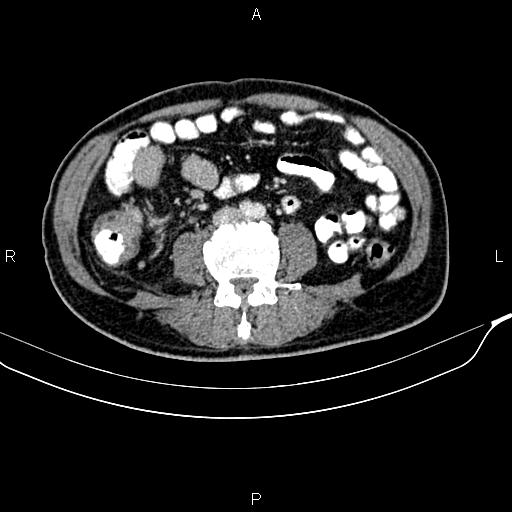 Cecal cancer with appendiceal mucocele (Radiopaedia 91080-108651 B 62).jpg
