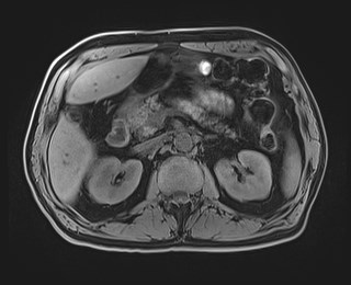 Cecal mass causing appendicitis (Radiopaedia 59207-66532 Axial T1 51).jpg