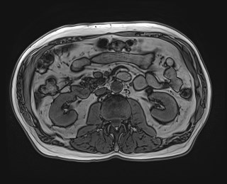 Cecal mass causing appendicitis (Radiopaedia 59207-66532 D 64).jpg