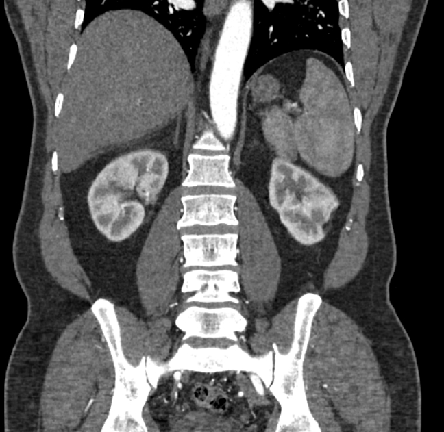 Celiac artery dissection (Radiopaedia 52194-58080 C 107).jpg