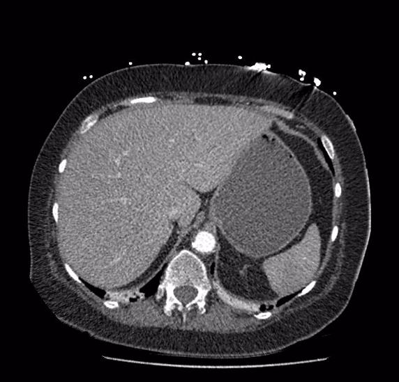 Celiac artery severe stenosis and dissection (Radiopaedia 44128-47842 B 13).jpg