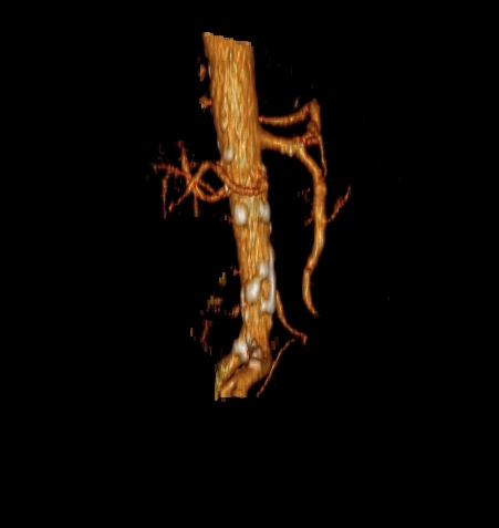 File:Celiacomesenteric trunk (Radiopaedia 67660-77071 VR C+ arterial phase 20).jpg