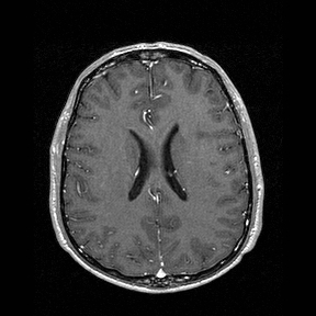 Central-variant posterior reversible encephalopathy syndrome (PRES) (Radiopaedia 43880-47358 Axial T1 C+ 104).jpg