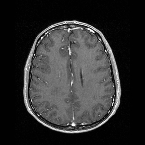 Central-variant posterior reversible encephalopathy syndrome (PRES) (Radiopaedia 43880-47358 Axial T1 C+ 112).jpg