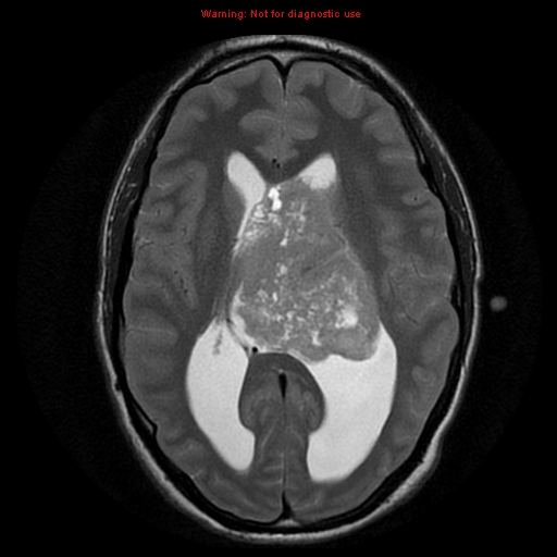 File:Central neurocytoma (Radiopaedia 13188-13206 Axial T2 3).jpg