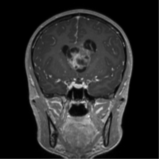 Central neurocytoma (Radiopaedia 37664-39557 Coronal T1 C+ 54).png