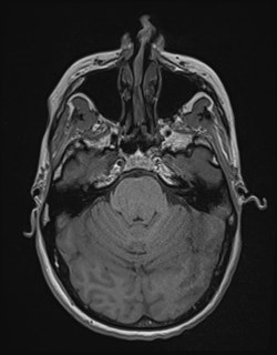 Central neurocytoma (Radiopaedia 84497-99872 Axial T1 63).jpg