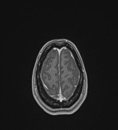 Central neurocytoma (Radiopaedia 84497-99872 Axial T1 C+ 135).jpg
