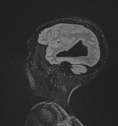 File:Central neurocytoma (Radiopaedia 84497-99872 Sagittal Flair + Gd 122).jpg