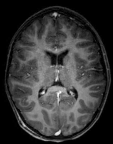 Cerebellar abscess (Radiopaedia 73727-84563 Axial T1 C+ fat sat 69).jpg