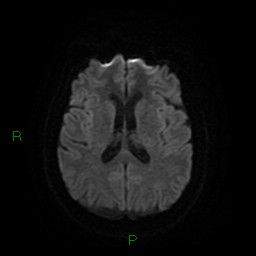 Cerebellar abscess (Radiopaedia 78135-90678 Axial DWI 18).jpg