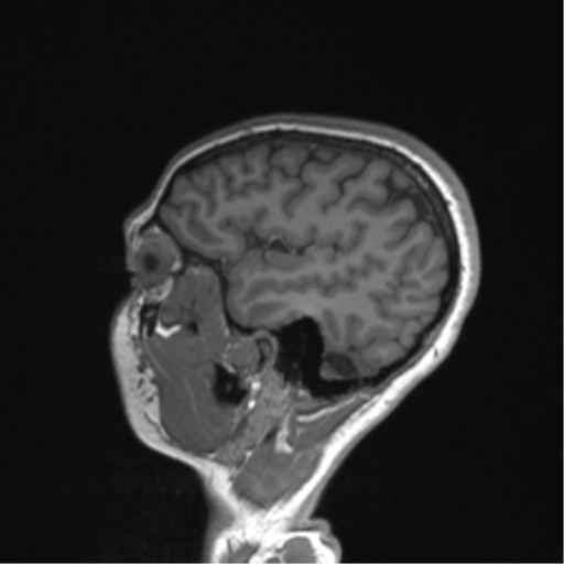 Cerebellar agenesis with hypoplastic pons (pontocerebellar hypoplasia) (Radiopaedia 57224-64138 Sagittal T1 52).png