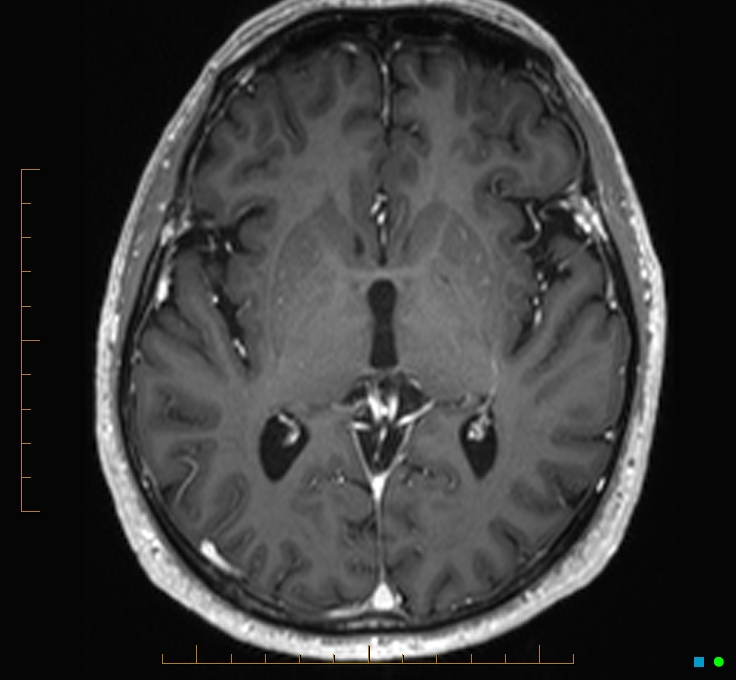 Cerebellar gangliocytoma (Radiopaedia 65377-74422 Axial T1 C+ 64).jpg