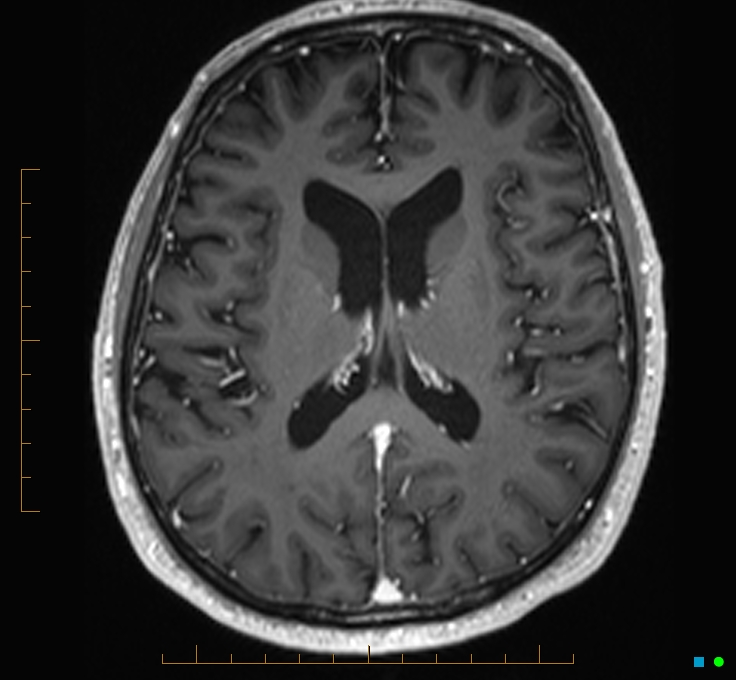 Cerebellar gangliocytoma (Radiopaedia 65377-74422 Axial T1 C+ 77).jpg