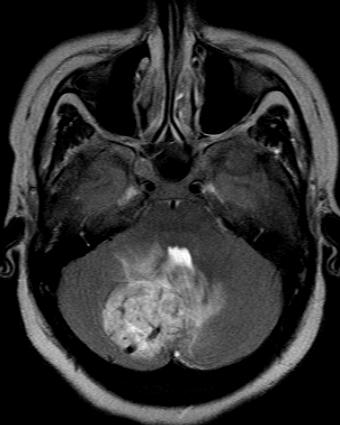 File:Cerebellar hemangioblastoma (Radiopaedia 10779-11234 Axial T2 1).JPG