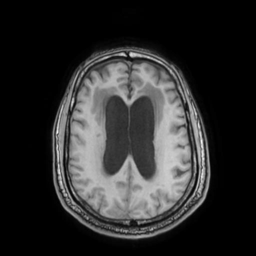 File:Cerebellar hemangioblastoma (Radiopaedia 88055-104622 Axial T1 24).jpg