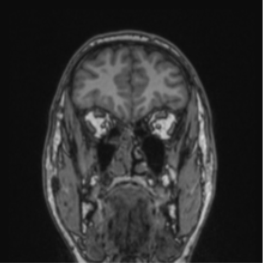 File:Cerebellar hemangioblastomas and pituitary adenoma (Radiopaedia 85490-101176 Coronal T1 71).png