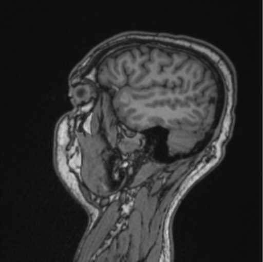 Cerebellar hemangioblastomas and pituitary adenoma (Radiopaedia 85490-101176 Sagittal T1 31).png