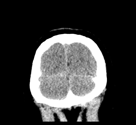 Cerebellar metastases - colorectal adenocarcinoma (Radiopaedia 40947-43652 Coronal non-contrast 85).png
