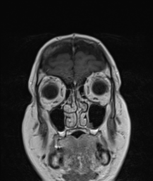 File:Cerebellar metastasis (Radiopaedia 54578-60810 Coronal T1 C+ 4).png