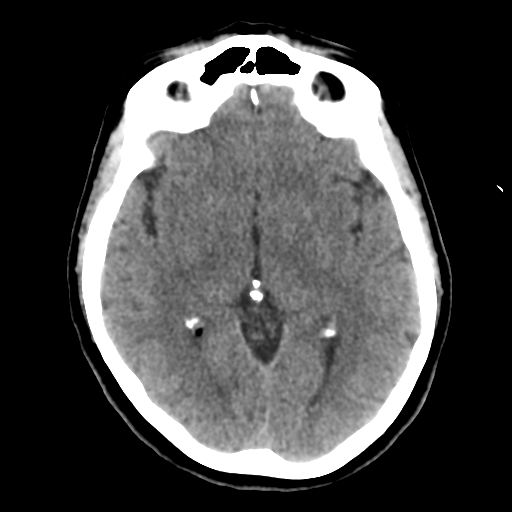 Cerebellar metastasis (cystic appearance) (Radiopaedia 41395-44258 Axial non-contrast 26).png