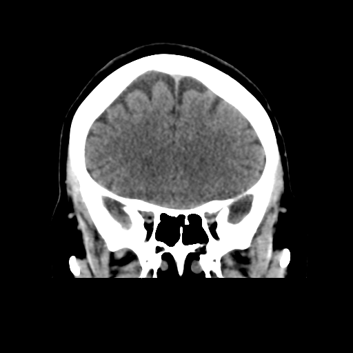 Cerebellar metastasis (cystic appearance) (Radiopaedia 41395-44258 Coronal non-contrast 21).png