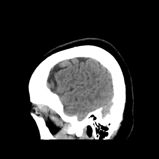 File:Cerebellar metastasis (cystic appearance) (Radiopaedia 41395-44258 E 12).png