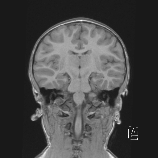 Cerebellar stroke (Radiopaedia 32202-33150 Coronal T1 33).png
