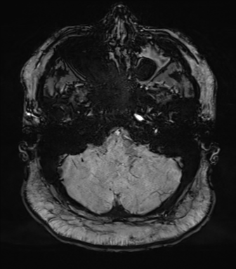 Cerebellopontine angle meningioma (Radiopaedia 48434-53348 Axial SWI 17).png
