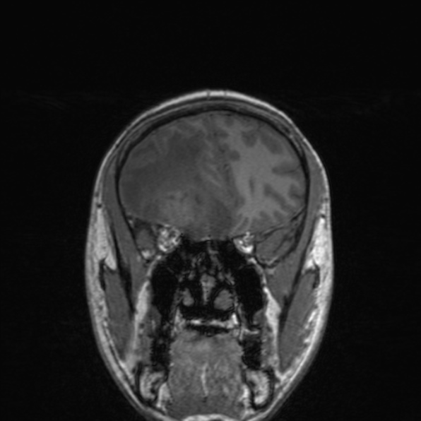 Cerebral abscess (Radiopaedia 24212-24478 Coronal T1 69).jpg