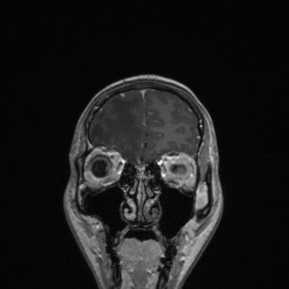Cerebral abscess (Radiopaedia 24212-24478 Coronal T1 C+ 50).jpg
