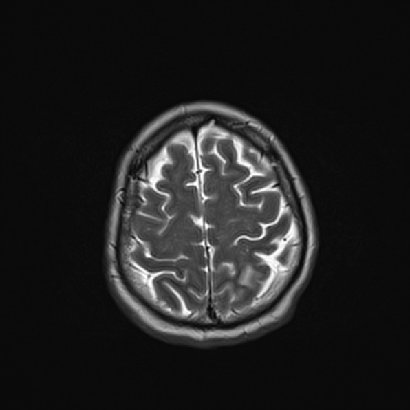 Cerebral abscess (Radiopaedia 26111-26247 Axial T2 49).jpg