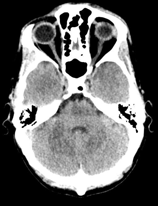 Cerebral abscess (Radiopaedia 60342-68008 Axial non-contrast 15).png