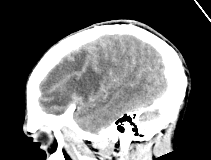 File:Cerebral abscess (Radiopaedia 60342-68008 Sagittal C+ delayed 41).png