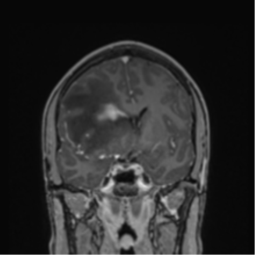 File:Cerebral abscess (Radiopaedia 60342-68009 H 30).png