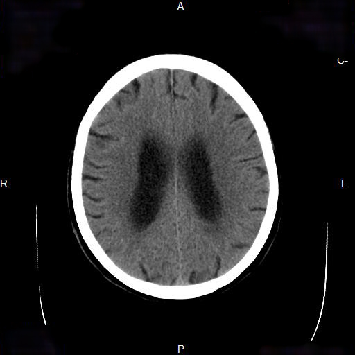 File:Cerebral abscess (Radiopaedia 7606-8431 Axial non-contrast 18).jpg