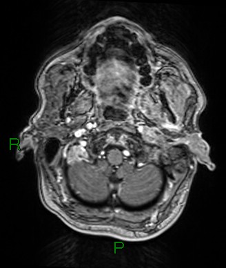 Cerebral abscess and subdural empyema (Radiopaedia 84436-99779 Axial T1 C+ 78).jpg