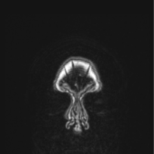 Cerebral abscess from pulmonary arteriovenous malformation (Radiopaedia 86275-102291 Coronal T1 89).png