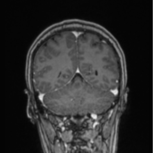 Cerebral abscess from pulmonary arteriovenous malformation (Radiopaedia 86275-102291 L 28).png