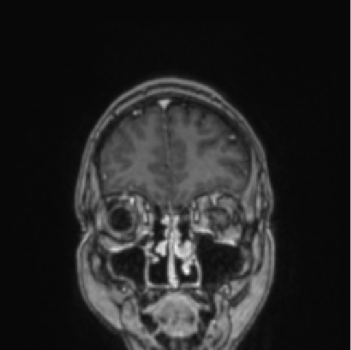 Cerebral abscess from pulmonary arteriovenous malformation (Radiopaedia 86275-102291 L 74).png