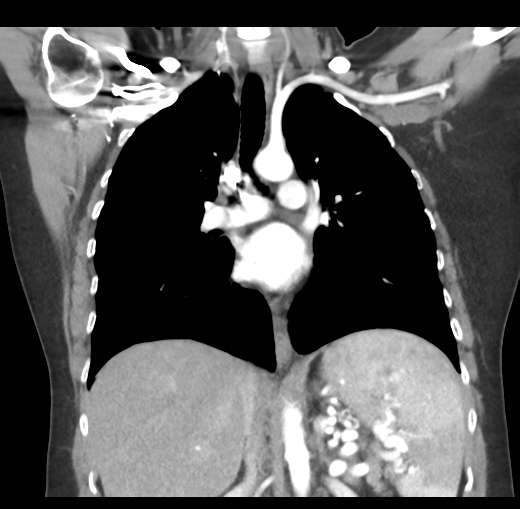 Cerebral abscess from pulmonary arteriovenous malformation (Radiopaedia 86275-102292 C 29).png