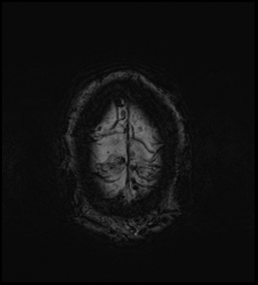 Cerebral abscess with ventriculitis (Radiopaedia 78965-91878 Axial SWI 49).jpg