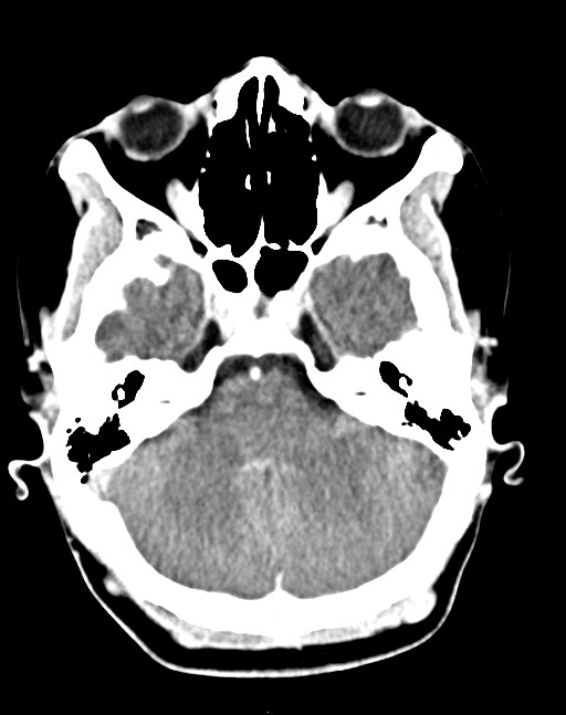 Cerebral abscesses (Radiopaedia 70458-80568 Axial Contrast 18).jpg