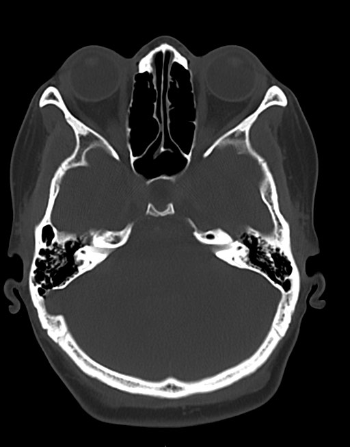 Cerebral abscesses (Radiopaedia 70458-80568 Axial bone window 19).jpg