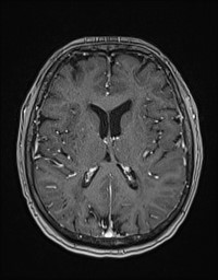 Cerebral amyloid angiopathy-related inflammation (Radiopaedia 58270-65377 Axial T1 C+ fat sat 83).jpg