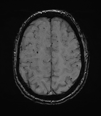 File:Cerebral amyloid angiopathy (Radiopaedia 46082-50433 Axial SWI 64).png