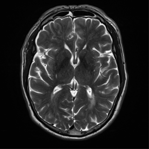 File:Cerebral amyloid angiopathy (Radiopaedia 46082-50433 Axial T2 19).png
